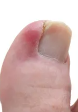 Ingrown toenail classified