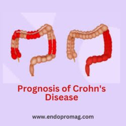 Prognosis of Crohn's Disease (5)
