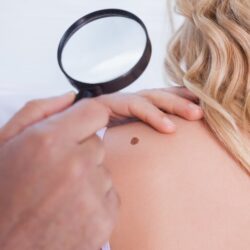 Reliable Quick Birthmark Removal Treatment in Rajasthan