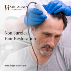 non surgical hair restoration(2)