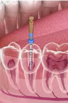 Root canal treatment classified