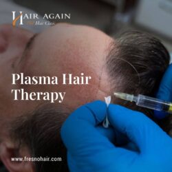 Plasma Hair Therapy (3)