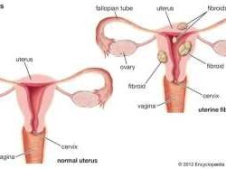 Uterine Fibroids type