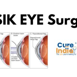 LASIK EYE Surgery