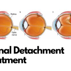 Retinal Detachment Treatment