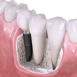 Dental Implants in Noida