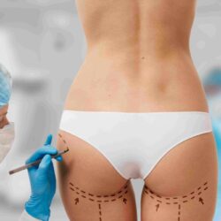 woman-marked-out-cosmetic-surgery (1)