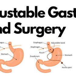 Adjustable Gastric Band Surgery in India