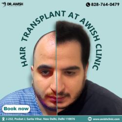 hair transplant ads