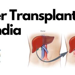 Best Choice for Liver Transplant in India