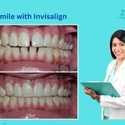 Best Invisalign Doctor in Sarjapur Road, Bangalore