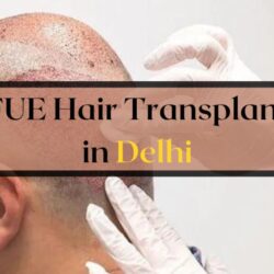 FUE Hair Transplant in Delhi (3)