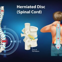 blog herniated disc