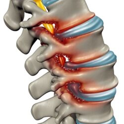 degenerative-disc-disease  real