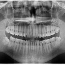 Dental-opg-xray-1-Ms medical