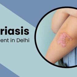 Psoriasis Treatment in Delhi