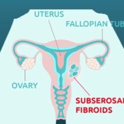 Subserosal-Fibroids