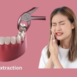 Tooth Extraction