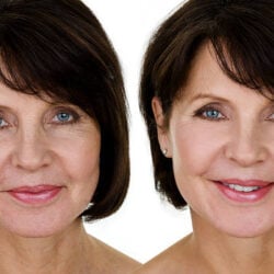 Wrinkle Reduction treatment warrenton