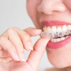 Invisalign braces