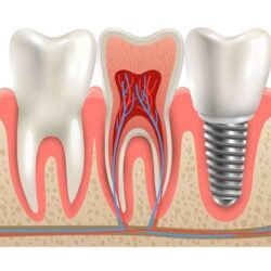 Dental Implants - Dant Ayush