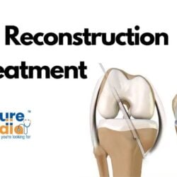 ACL Reconstruction Treatment