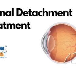 Retinal Detachment Treatment (1)