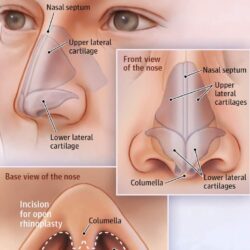 Rhinoplasty