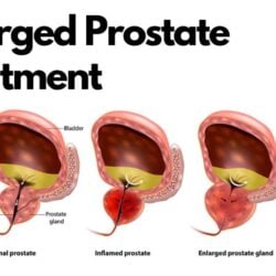 Enlarged Prostate Treatment in India