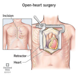 open-heart-surgery