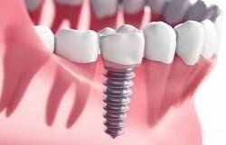 download (40)Dental implants jacksonville fl pic