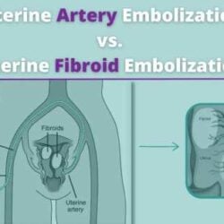 A Synonym for Uterine Fibroid Embolization is