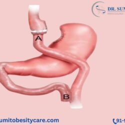 Best Laparoscopic Banded Gastric Bypass Treatment in Bangalore