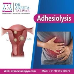 adhesiolysis