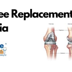 Knee Replacement in India