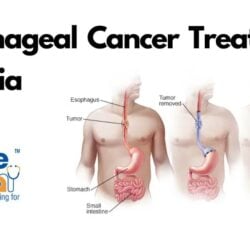 Esophageal Cancer Treatment in India