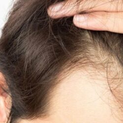 hair transplant in indirapuram