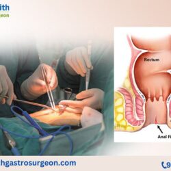 Laser Treatment for Fissure in Bangalore