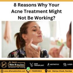 8 Reasons Why Your Acne Treatment Might Not Be Working