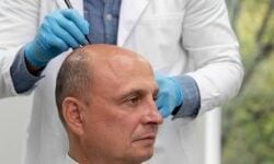 hair-transplantation