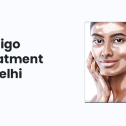 Vitiligo Treatment In Delhi