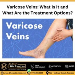 varicose veins