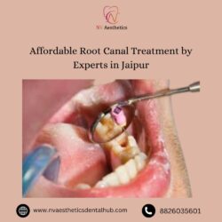 Affordable Root Canal Treatment by Experts in Jaipur