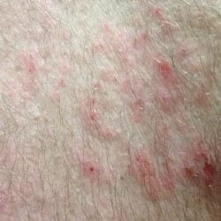 Atopic dermatitis Houston