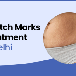 Stretch Marks Treatment in Delhi