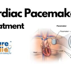 Cardiac Pacemaker Treatment in India