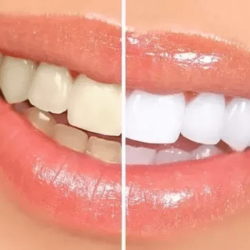 Dental-Bleaching-Treatment